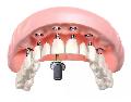 увеличить Имплантация на 6 имплантах цена в стоматологии Свой Дантист в Мытищах